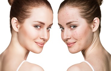 Acne 2 faces of a Girl