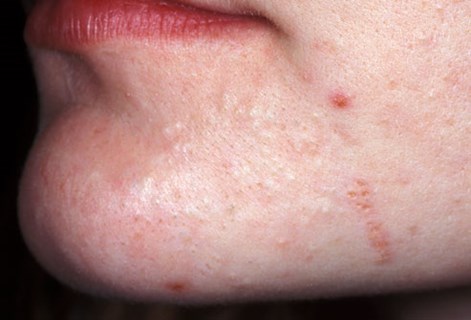 Acne Mild