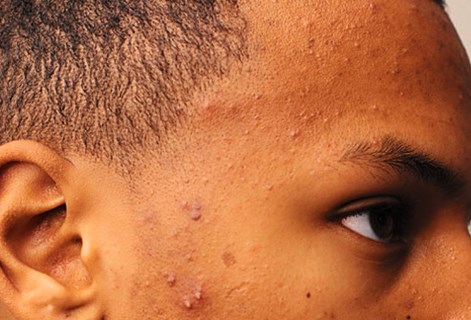 Acne Moderate