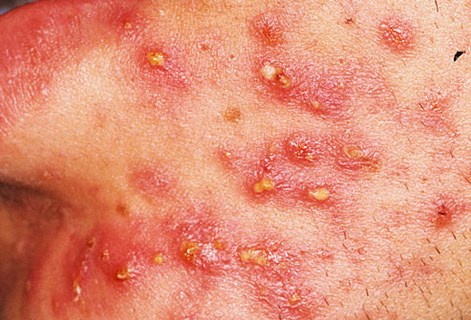Acne Severe