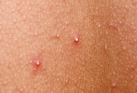 Acne Whiteheads