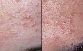 A face with acne