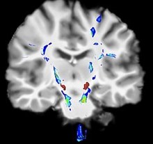 A brain scan showing substantia nigra in red. Source: medicalimages.com