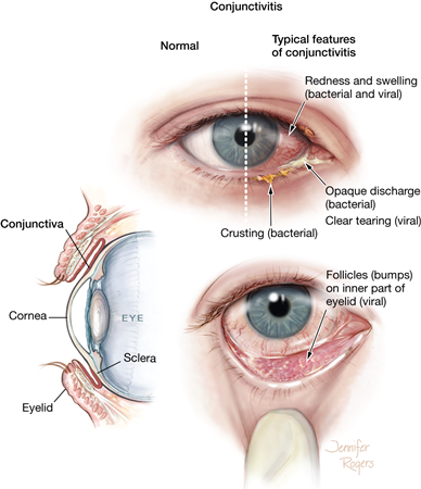 Conjunctivitis